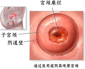 宫颈炎